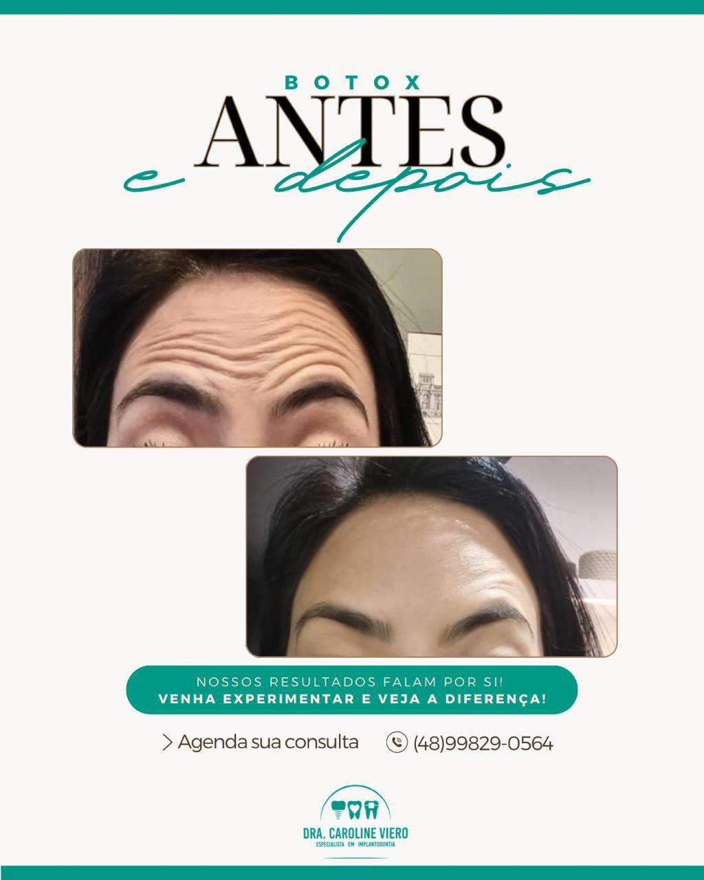 Harmonização com Botox