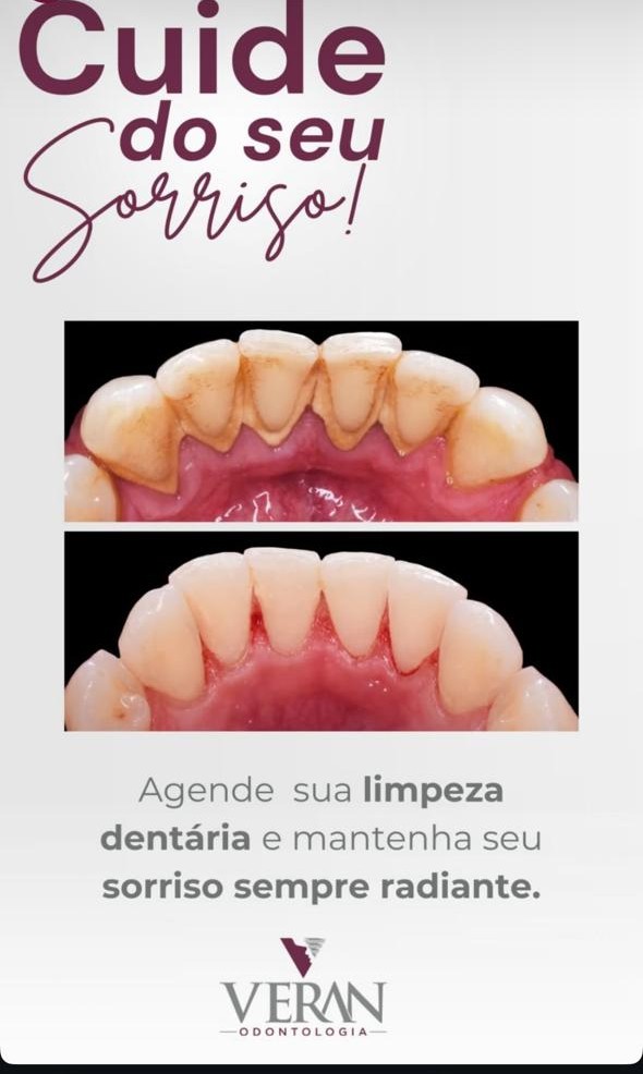 Limpeza & Profilaxia